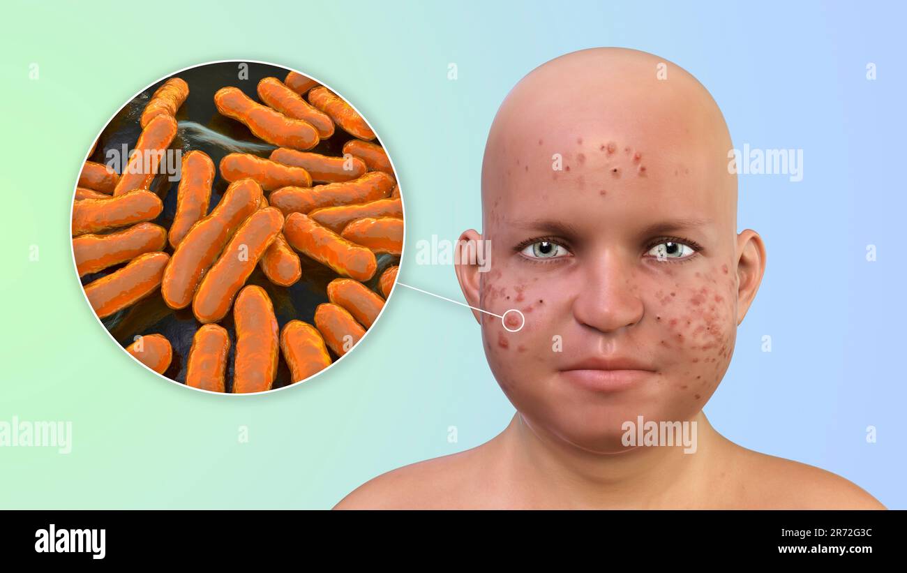 Vulgaris dell'acne sulla faccia del ragazzo dell'adolescenza in sovrappeso e vista ravvicinata dei batteri che causano l'acne, illustrazione del calcolatore. L'acne è un nome generale dato t Foto Stock