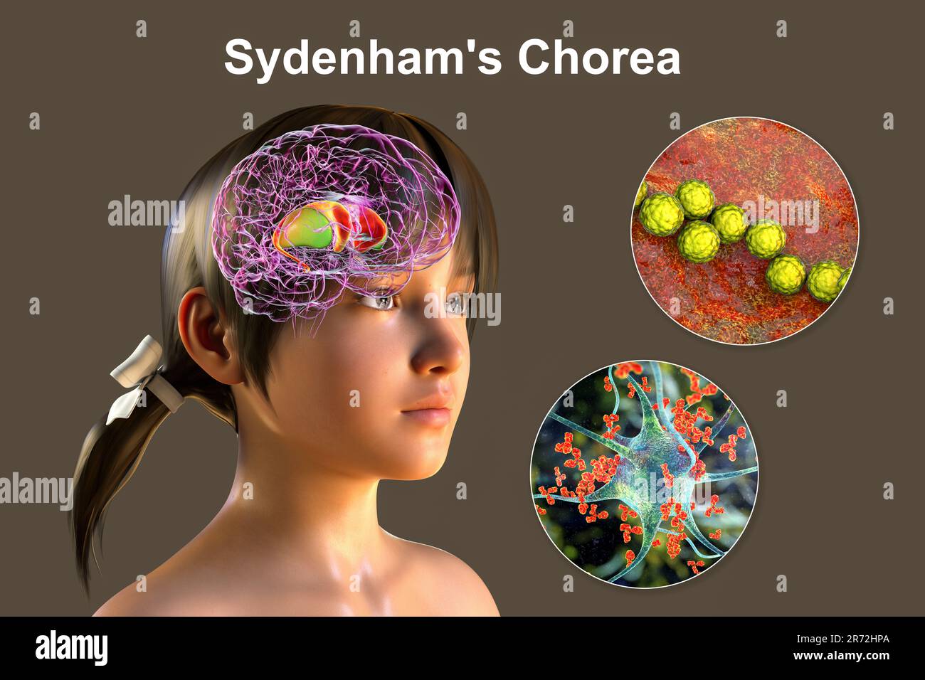 La Corea di Sydenham, una malattia autoimmune che deriva dall'infezione da Streptococco, formazione di anticorpi anti-neuronali che danneggiano i gangli basali cerebrali Foto Stock