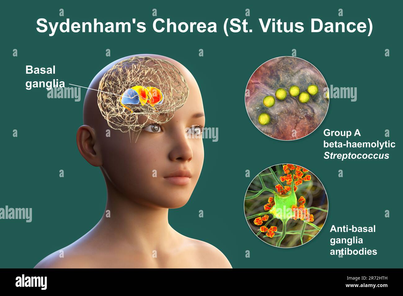 La Corea di Sydenham, una malattia autoimmune che deriva dall'infezione da Streptococco, formazione di anticorpi anti-neuronali che danneggiano i gangli basali cerebrali Foto Stock