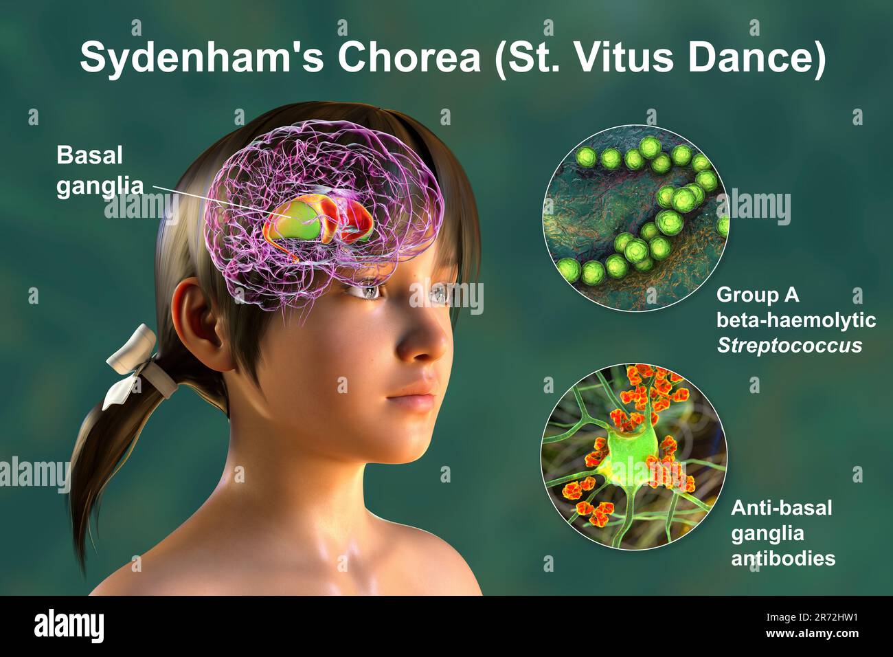 La Corea di Sydenham, una malattia autoimmune che deriva dall'infezione da Streptococco, formazione di anticorpi anti-neuronali che danneggiano i gangli basali cerebrali Foto Stock