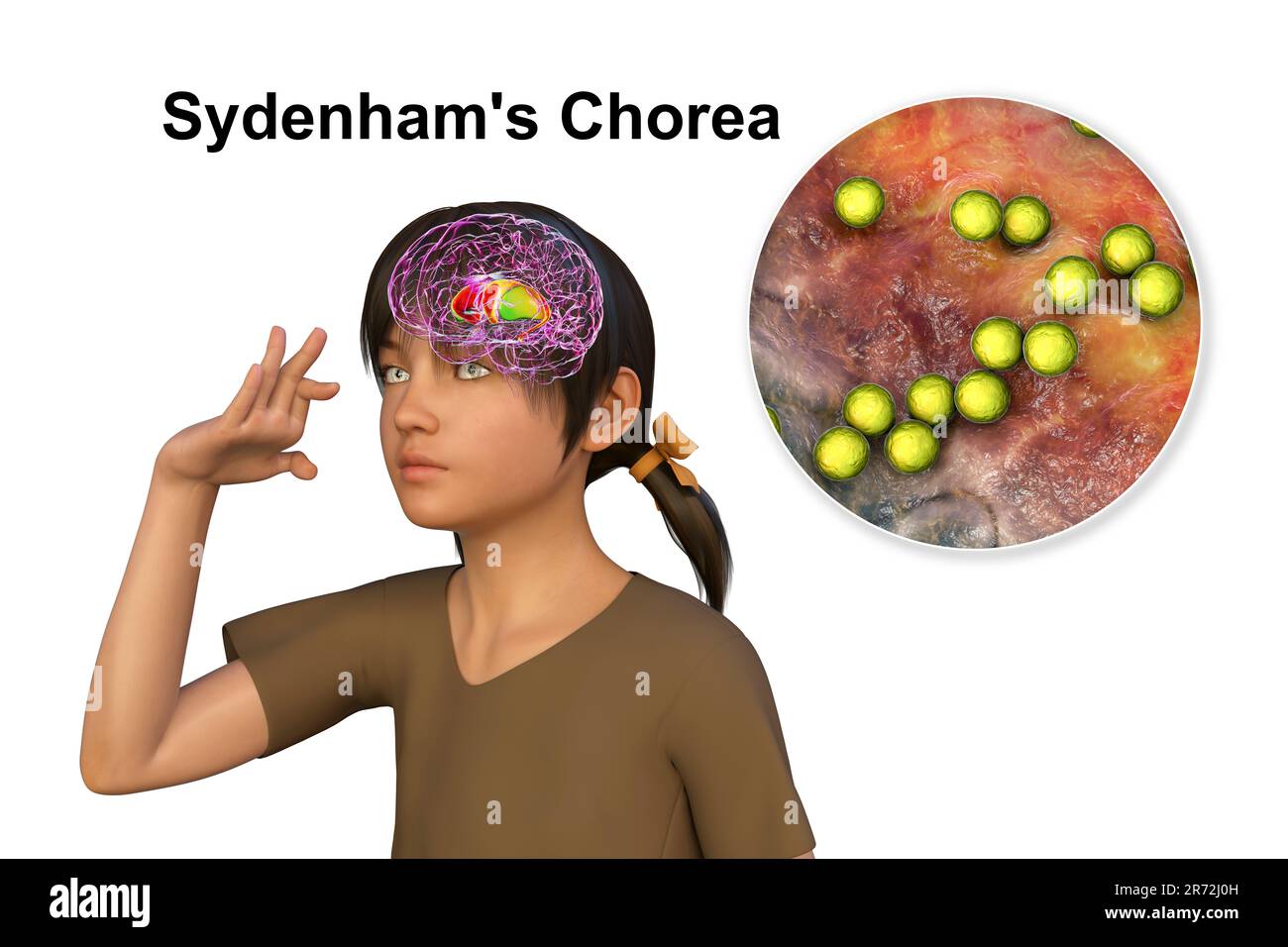 La Corea di Sydenham, una malattia autoimmune che deriva dall'infezione da Streptococco, formazione di anticorpi anti-neuronali che danneggiano i gangli basali cerebrali Foto Stock