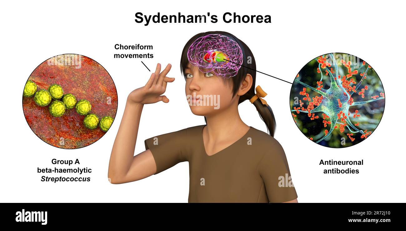 La Corea di Sydenham, una malattia autoimmune che deriva dall'infezione da Streptococco, formazione di anticorpi anti-neuronali che danneggiano i gangli basali cerebrali Foto Stock