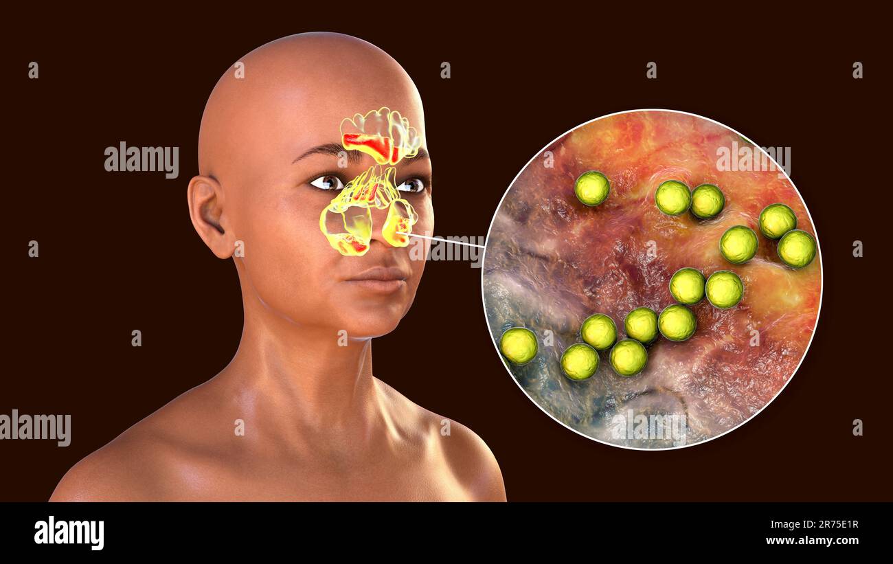 Streptococcus pyogenes batteri come causa di sinusite. Illustrazione del computer che mostra l'infiammazione dei seni frontali, etmoidi e mascellari e del clo Foto Stock