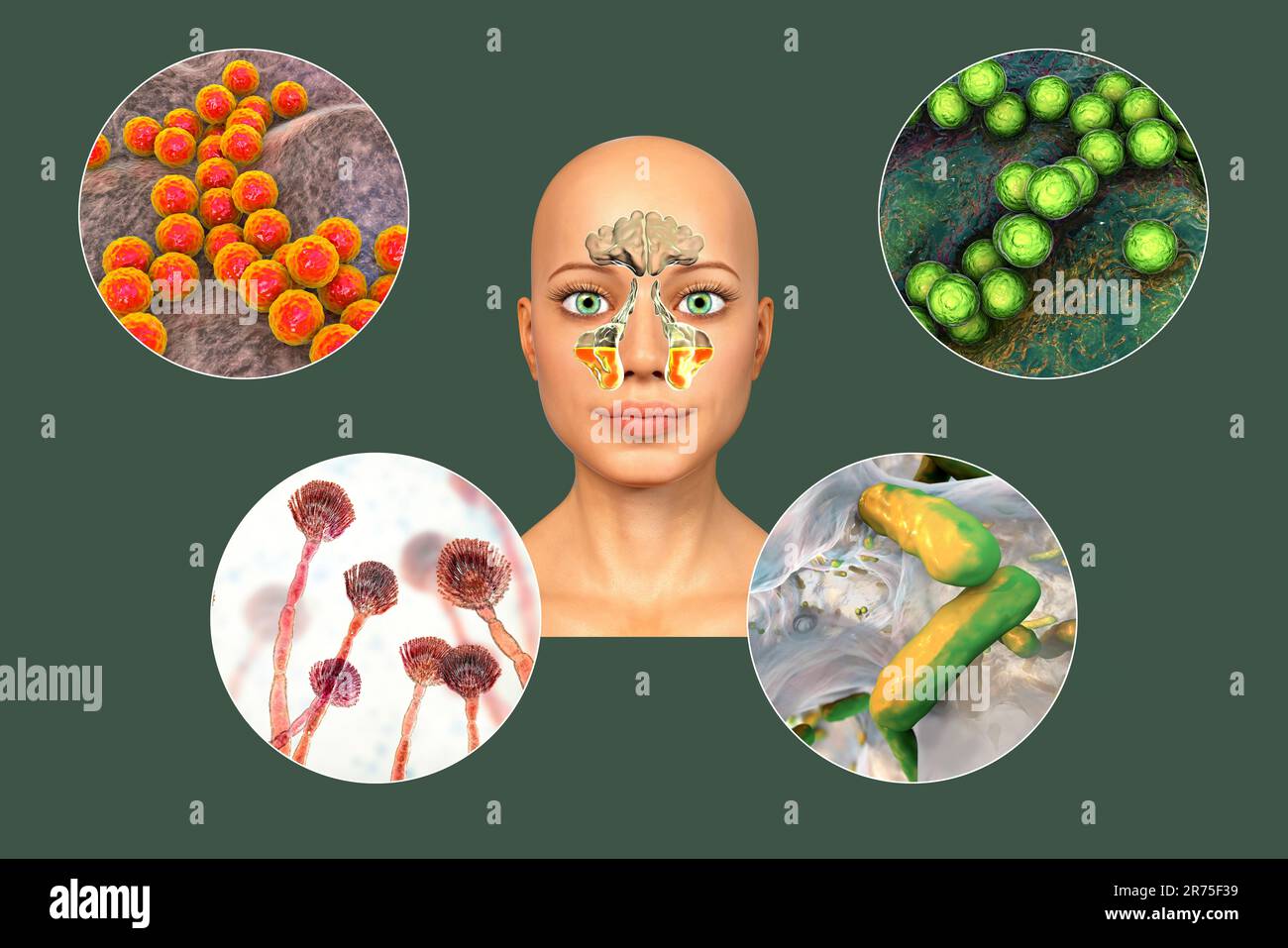 Anatomia della rinosinusite e microrganismi che causano sinusite. Streptococcus pneumoniae, Streptococcus mutans, Aspergillus fumigatus e Pseudomo Foto Stock