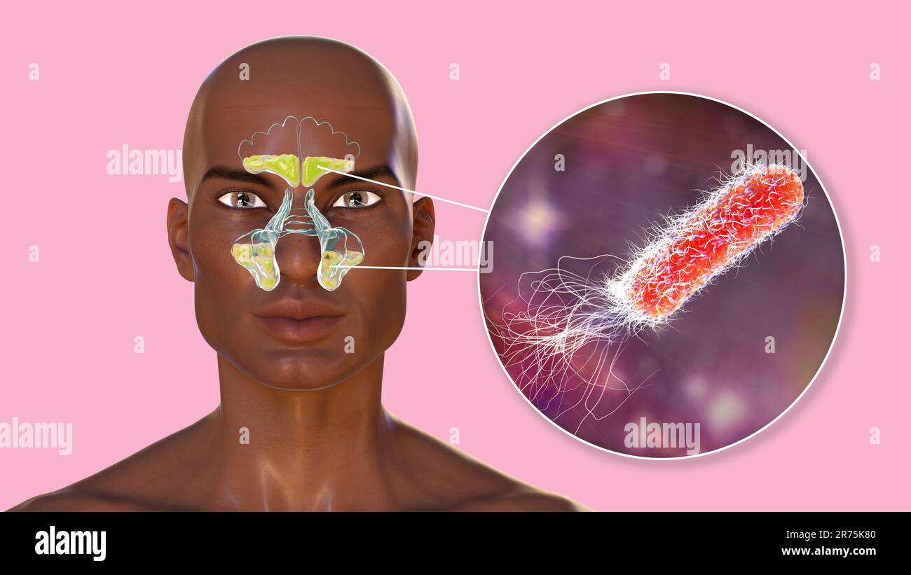 Sinusite batterica, computer illustrazione. I seni sono spazi riempiti d'aria rivestiti da membrana nelle ossa del viso. Sinusite, nota anche come sinu Foto Stock