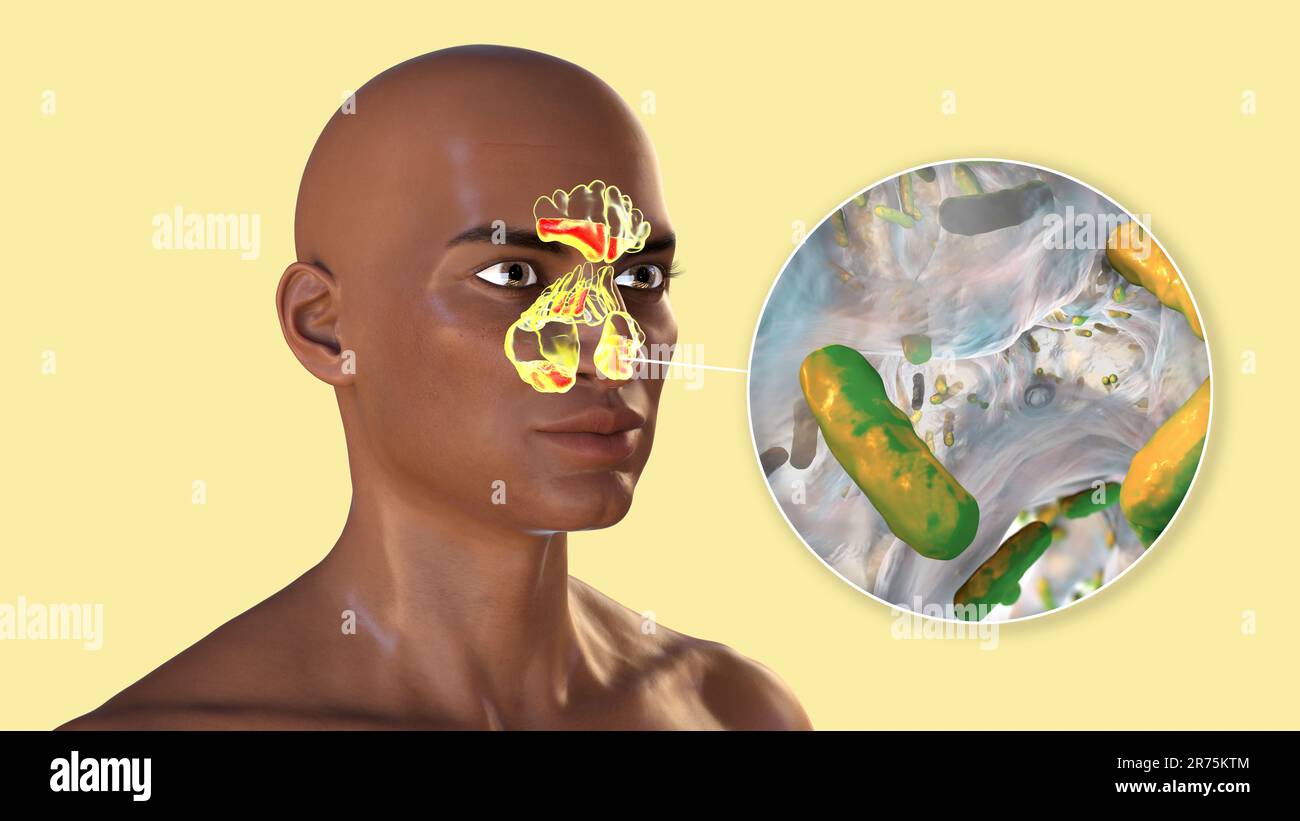 Sinusite batterica, illustrazione del computer. I seni sono spazi riempiti d'aria con membrana nelle ossa del viso. I seni frontali sono superiori a t. Foto Stock