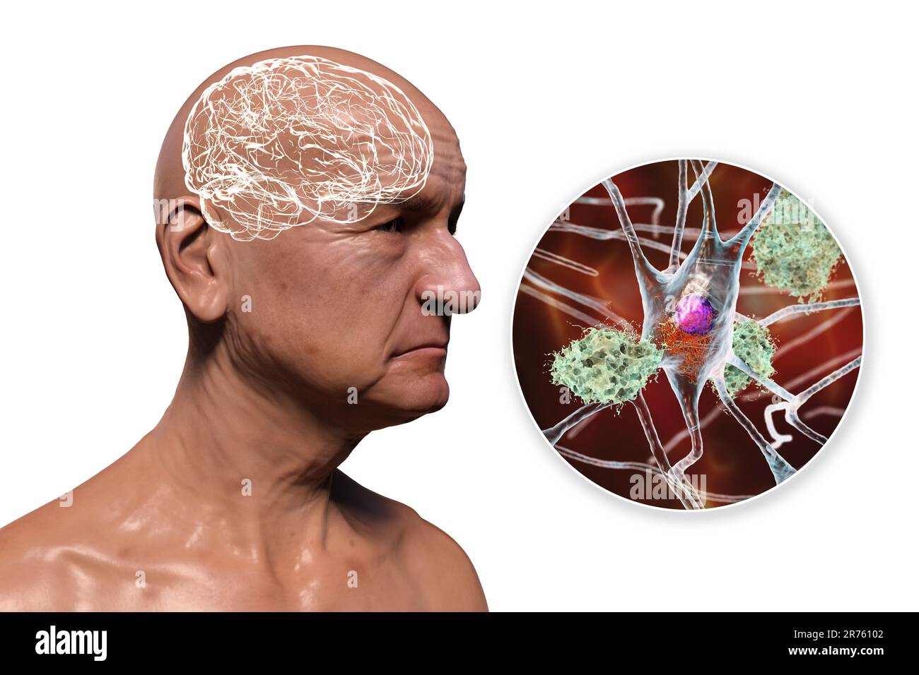Morbo di Alzheimer, illustrazione concettuale del computer che mostra una persona anziana con disabilità progressive delle funzioni cerebrali, placche amiloidi in br Foto Stock