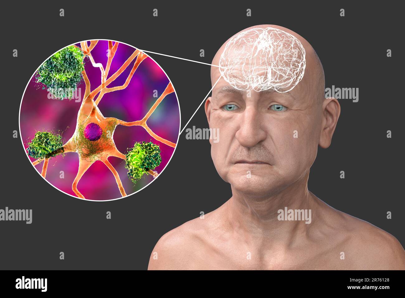 Morbo di Alzheimer, illustrazione concettuale del computer che mostra una persona anziana con disabilità progressive delle funzioni cerebrali, placche amiloidi in br Foto Stock