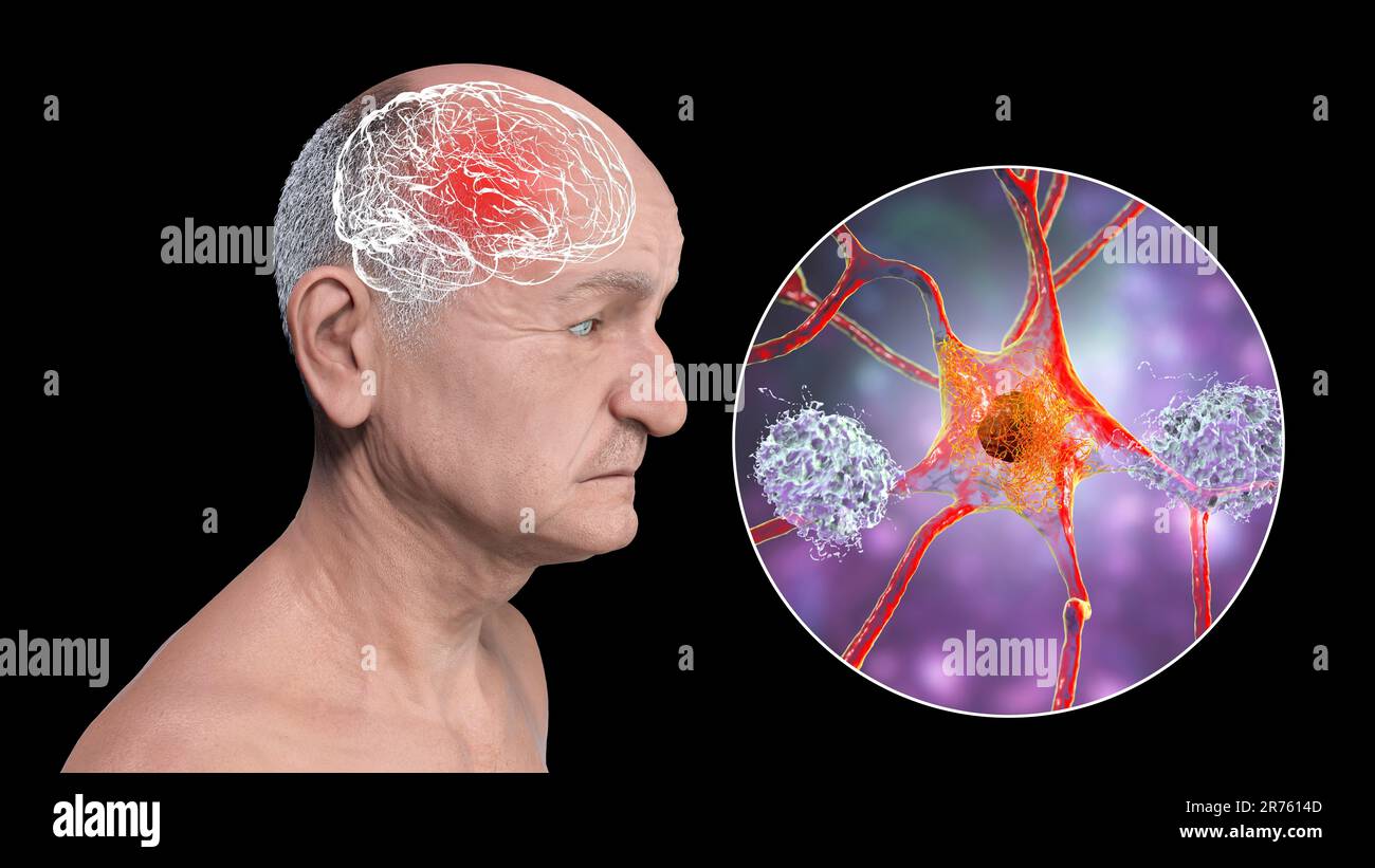 Morbo di Alzheimer, illustrazione concettuale del computer che mostra una persona anziana con disabilità progressive delle funzioni cerebrali, placche amiloidi in br Foto Stock