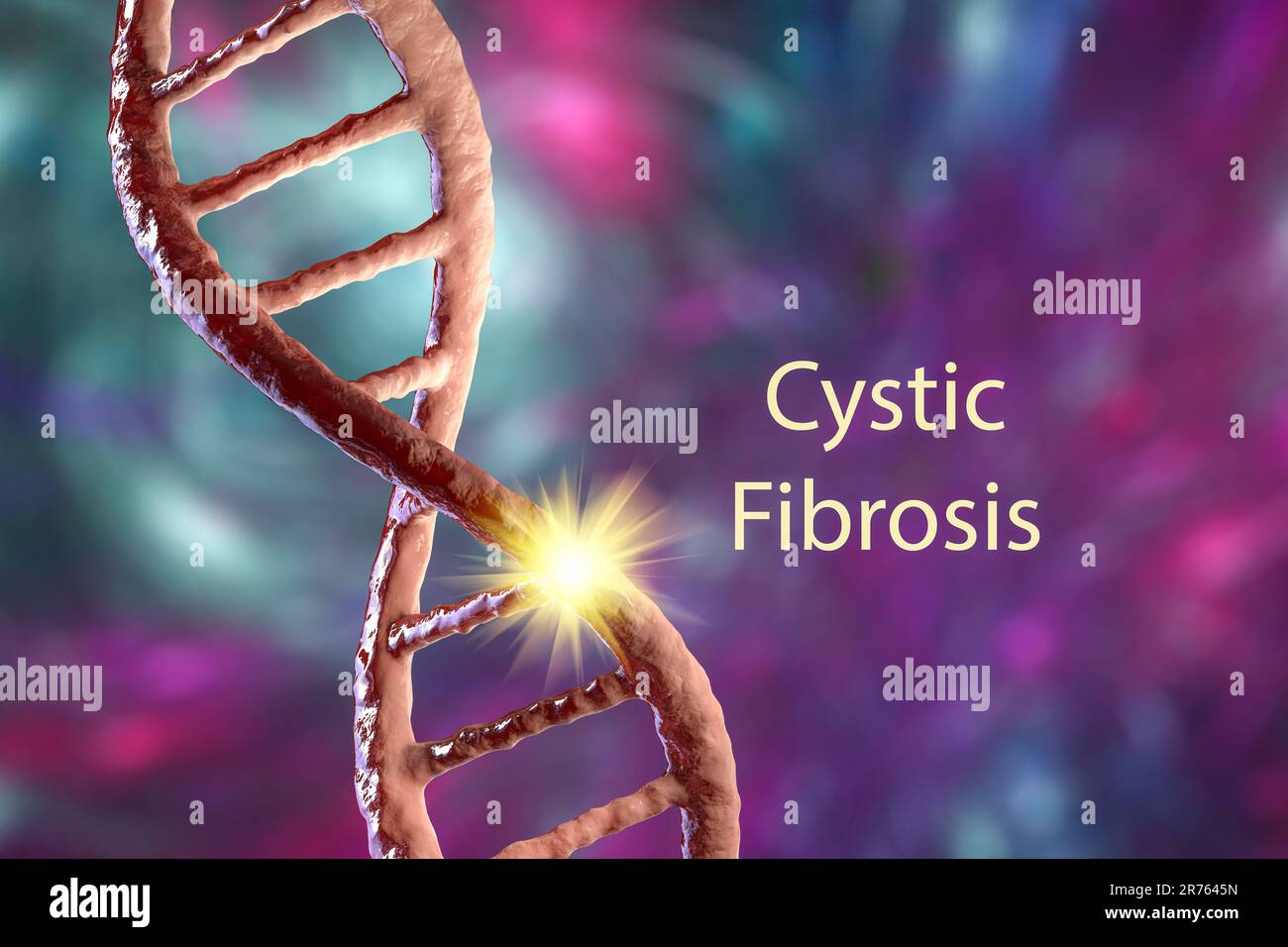 Illustrazione della fibrosi cistica, una condizione ereditaria (chiamata anche mucoscidosi) provoca l'ostruzione delle vie aeree (bronchi) con muco, caustina Foto Stock