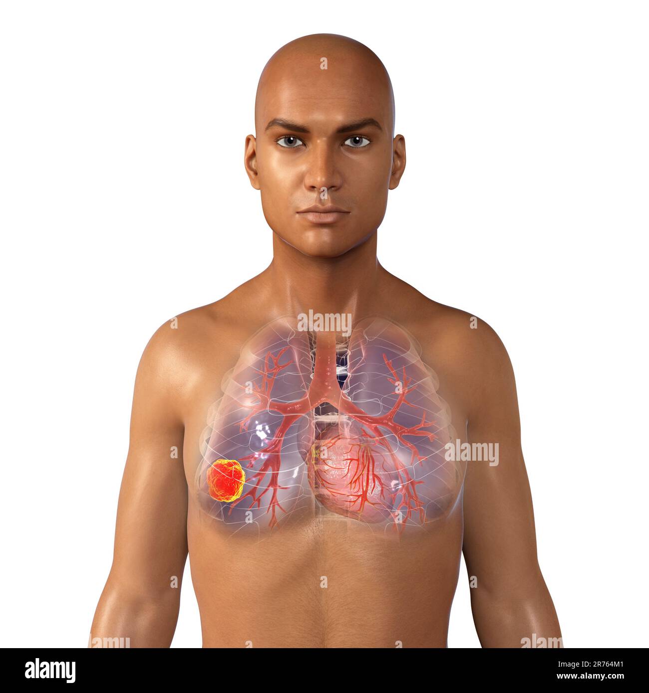 Il cancro del polmone, illustrazione del computer. Foto Stock