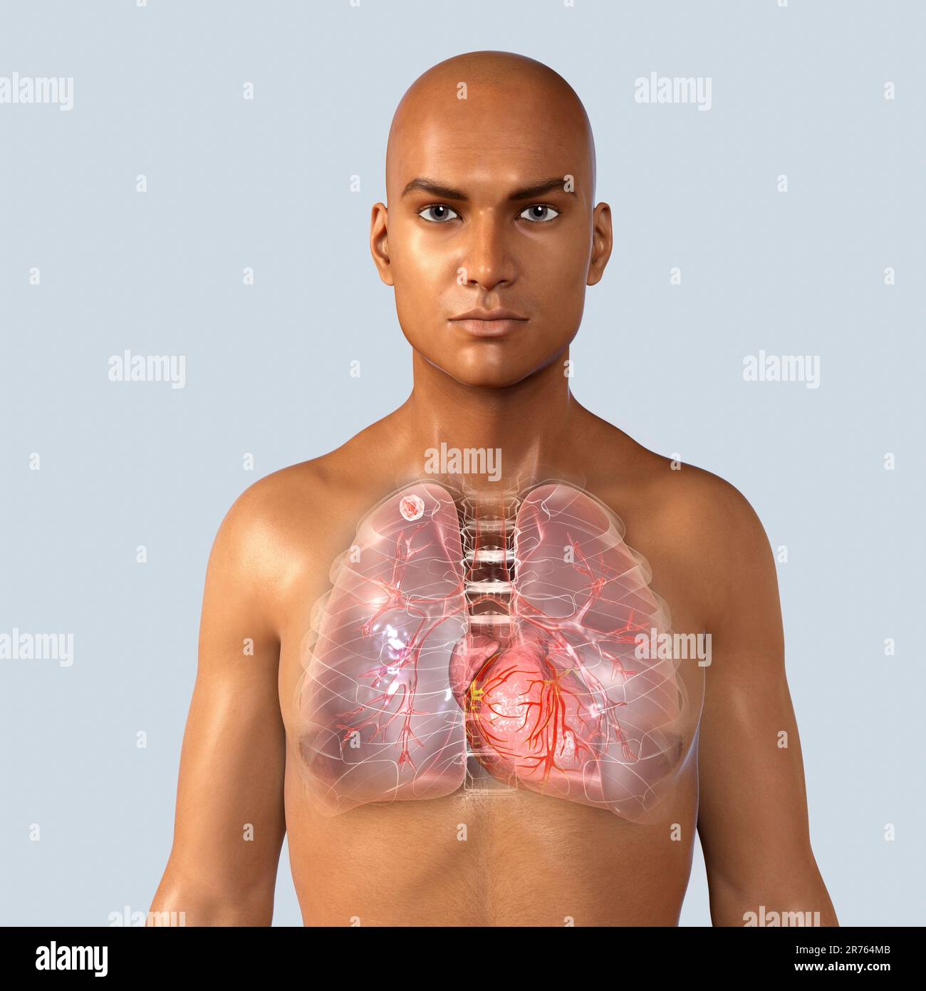 Secondaria infezione da tubercolosi. Computer illustrazione che mostra di piccole dimensioni nodulare solida massa situato nel lobo superiore del polmone destro vicino all apice del polmone. Foto Stock