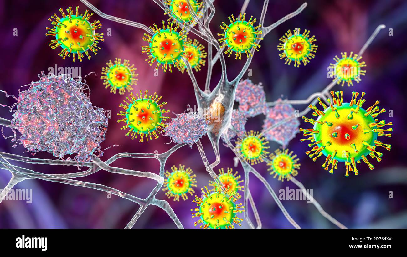 Eziologia infettiva della demenza, illustrazione concettuale al computer. Sequele neuropsichiatriche di Covid-19. Virus che infettano neuroni e im progressivi Foto Stock