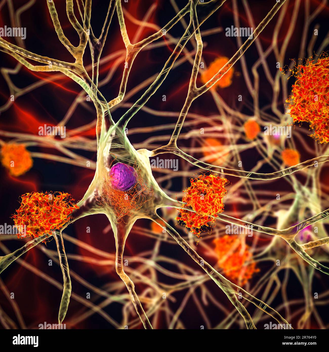 Malattia di Alzheimer. Illustrazione di placche amiloidi tra neuroni e grovigli neurofibrillari all'interno dei neuroni. Le placche amiloidi sono fe caratteristico Foto Stock