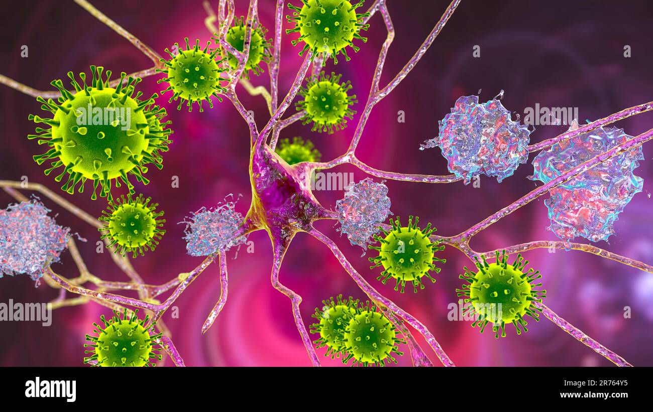 Eziologia infettiva della demenza, illustrazione concettuale al computer. Sequele neuropsichiatriche di Covid-19. Virus che infettano neuroni e im progressivi Foto Stock