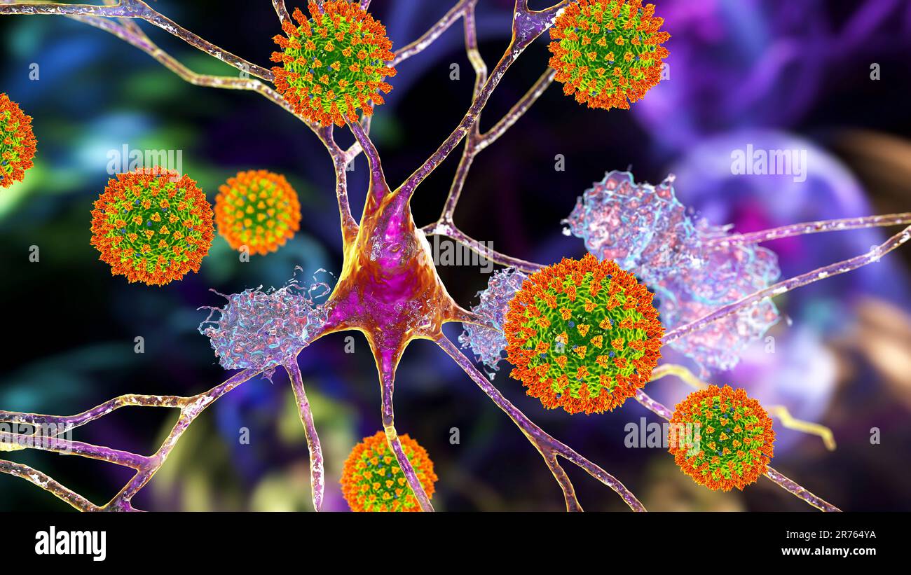 Covid-19 e demenza, sequele neuropsichiatriche di Covid-19, illustrazione concettuale al computer che mostra i neuroni che danneggiano i coronavirus e la placche amiloide Foto Stock