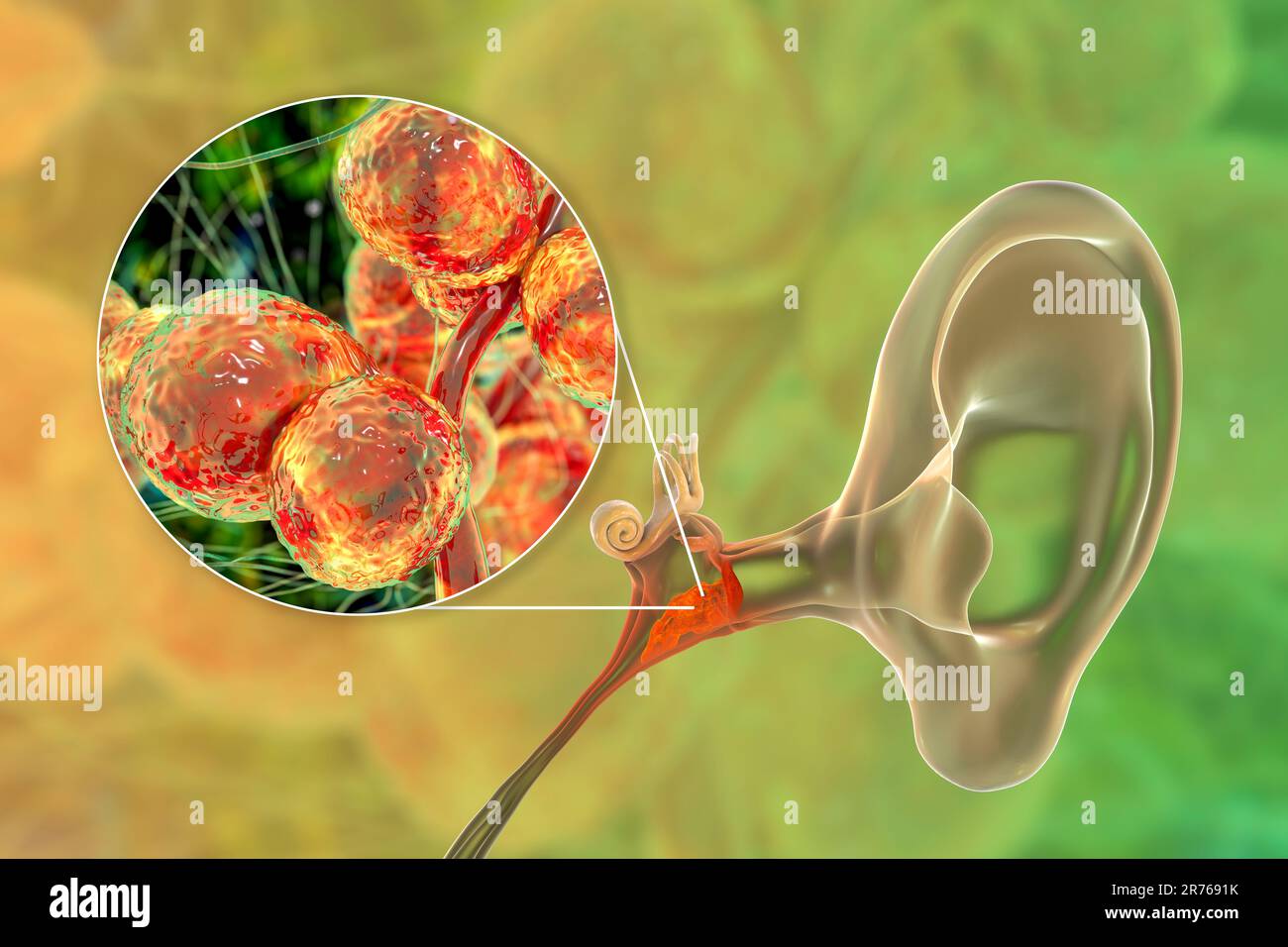 Otite fungina cronica media infezione dell'orecchio. Illustrazione del computer che mostra l'infiammazione dell'orecchio medio e vista ravvicinata dei funghi Candida albicans, t Foto Stock