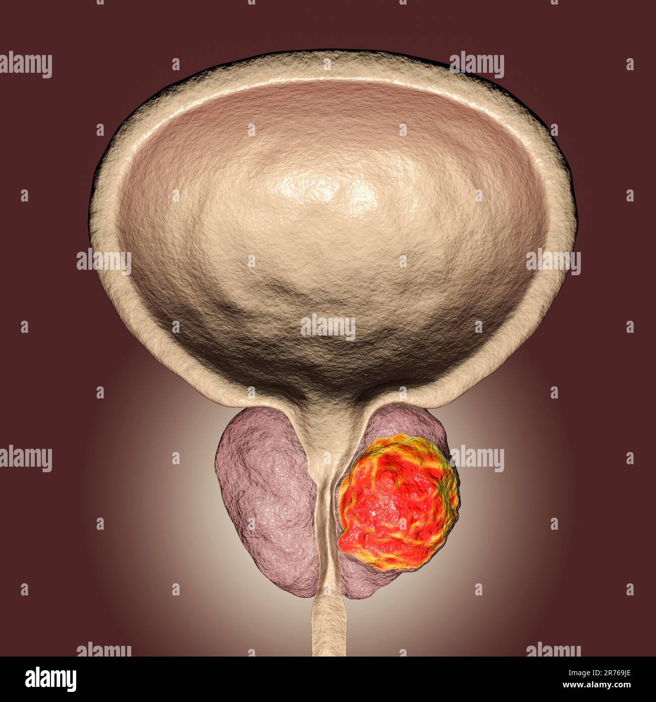 Cancro della prostata. Illustrazione computerizzata di un tumore canceroso (al centro a destra) nella ghiandola prostatica (bianca, al centro). L'uretra può essere visto che corre giù Foto Stock