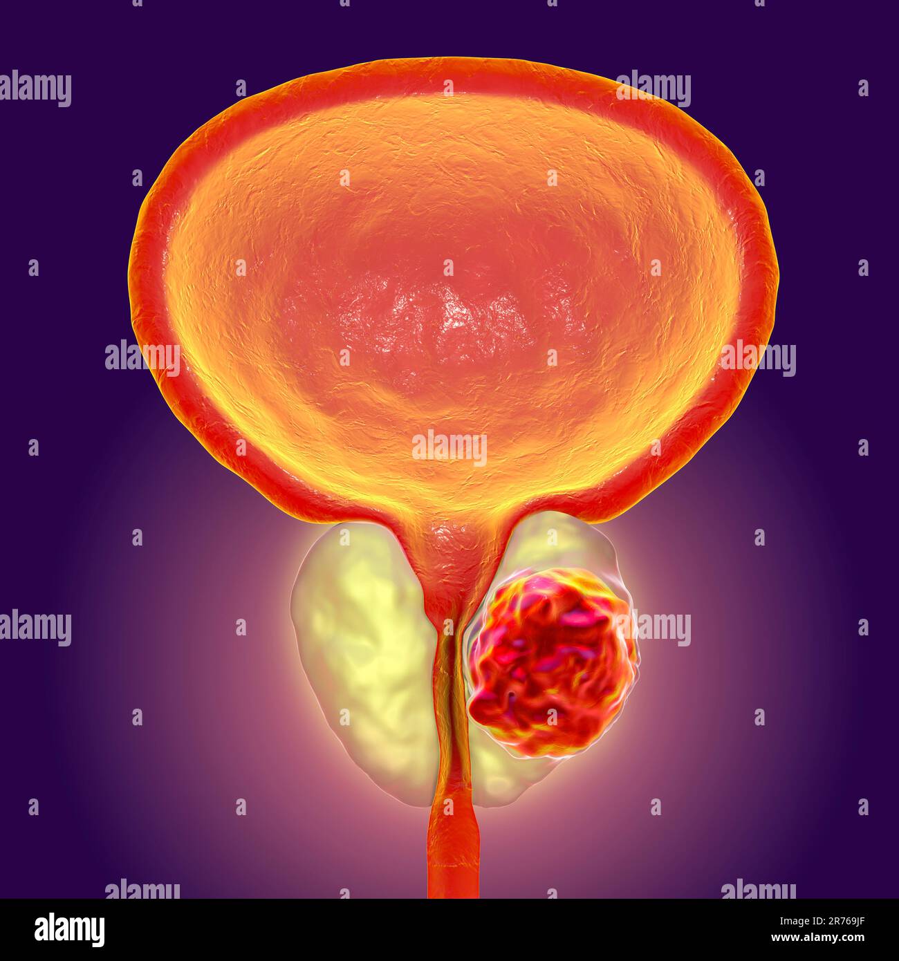 Cancro della prostata. Illustrazione computerizzata di un tumore canceroso (al centro a destra) nella ghiandola prostatica (bianca, al centro). L'uretra può essere visto che corre giù Foto Stock