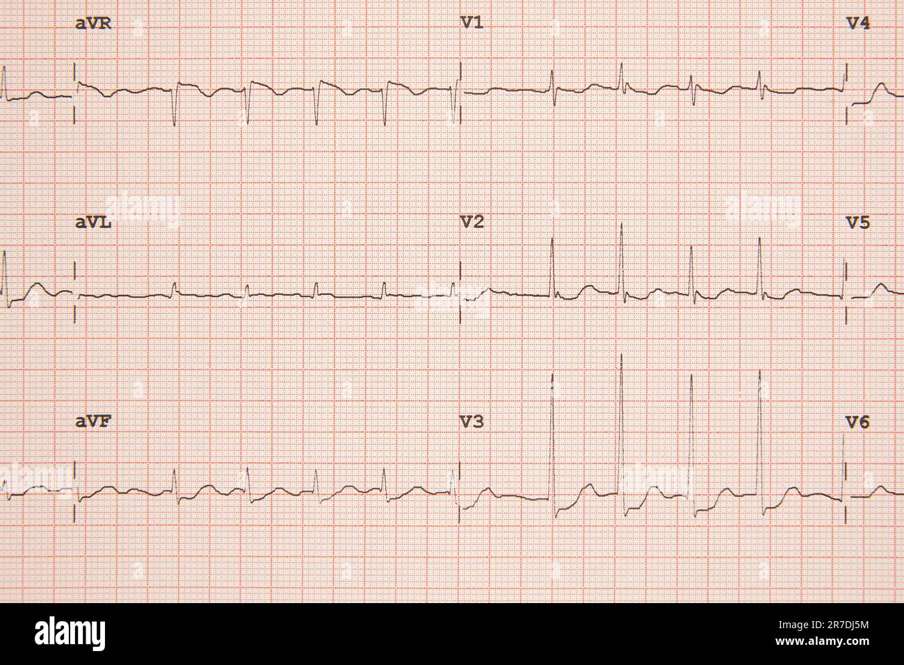 Elettrocardiogramma grafico su carta. Diagnosi medica. Assistenza sanitaria. Cardiologo Foto Stock
