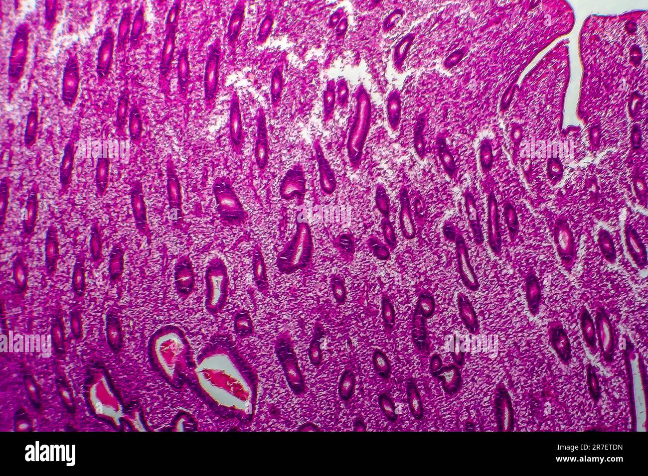 Iperplasia endometriale. Micrografia di luce di una sezione attraverso il tessuto dall'endometrio, in un caso di iperplasia endometriale. L'endometrio è t Foto Stock