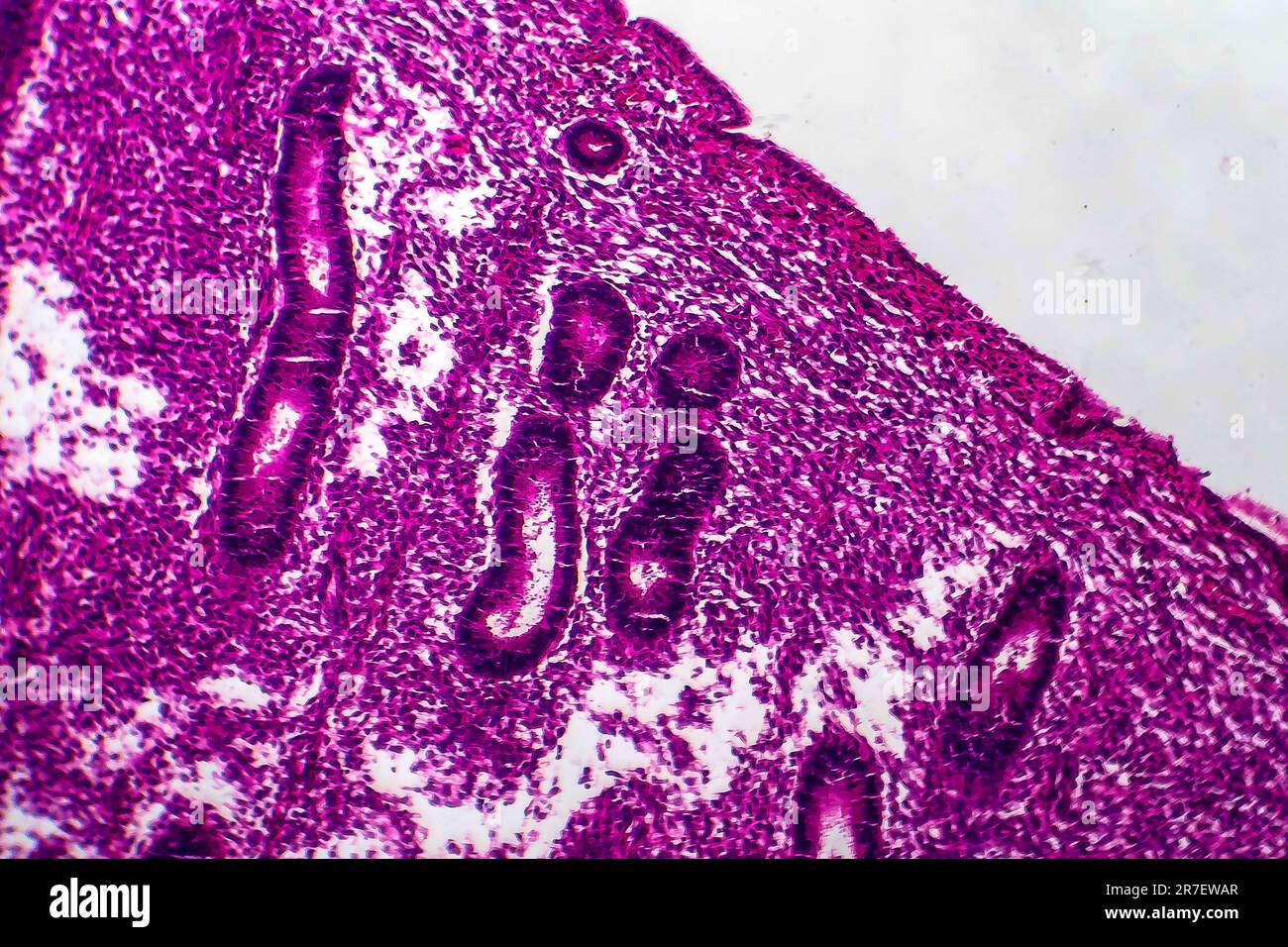 Iperplasia endometriale. Micrografia di luce di una sezione attraverso il tessuto dall'endometrio, in un caso di iperplasia endometriale. L'endometrio è t Foto Stock