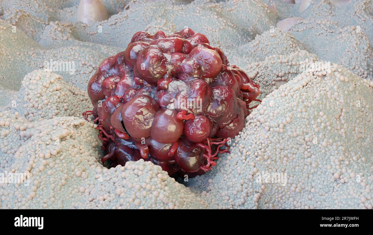 Crescita delle cellule tumorali incontrollabile sui tessuti, cellule di infezione tumorale e diffusione, metastasi infiammatoria invasiva cancerosa. riproduzione tramite duplicati Foto Stock