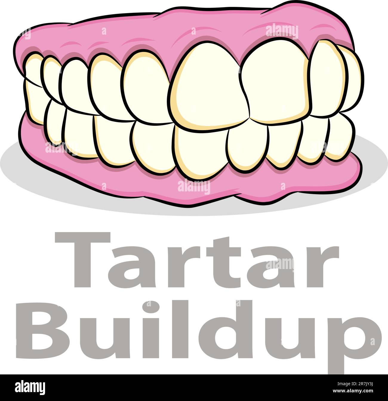 L' immagine di un accumulo di tartaro sui denti. Illustrazione Vettoriale