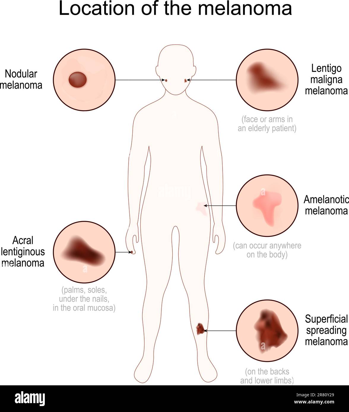 Posizione del melanoma. Silhouette del corpo umano con nodulare, lentiginosa acrale, lentigo maligna, diffusione superficiale e melanoma amelanotico. Chiudi Illustrazione Vettoriale