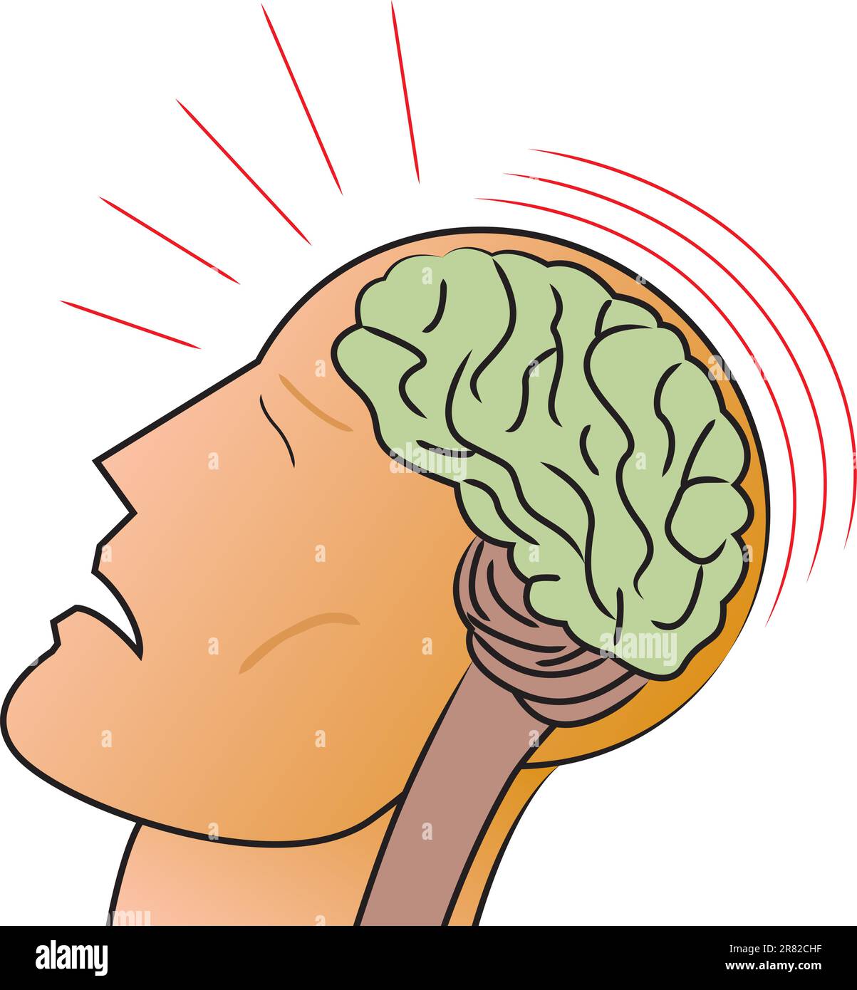 Rappresentazione stilizzata di un uomo che ha subito una lesione traumatica alla testa o una commozione cerebrale. Illustrazione Vettoriale