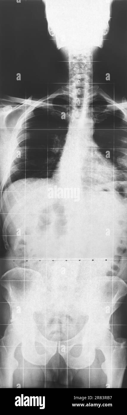 Imaging di risonanza radiografica. Colonna vertebrale maschile. Diagnosi di procedura medica. Radiologia Foto Stock