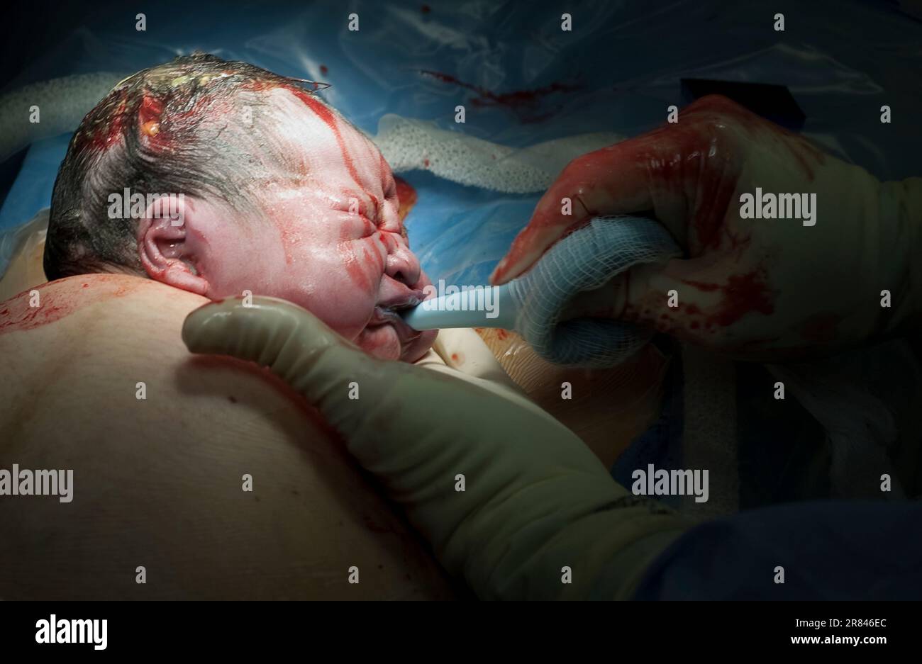 Bambino asiatico nato tramite c-section Foto Stock