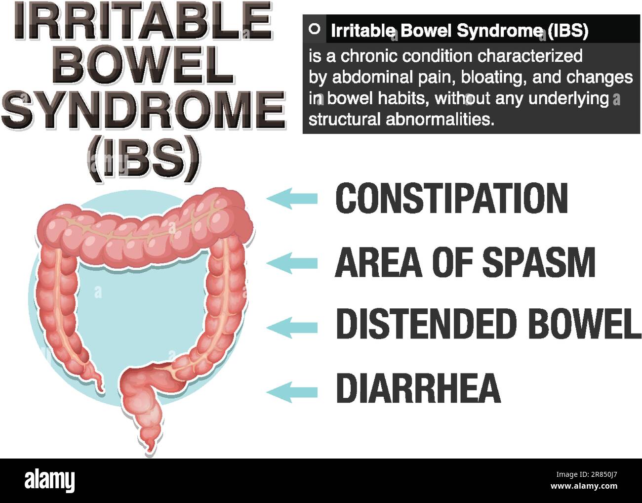 Illustrazione infografica della sindrome dell'intestino irritabile (IBS) Illustrazione Vettoriale