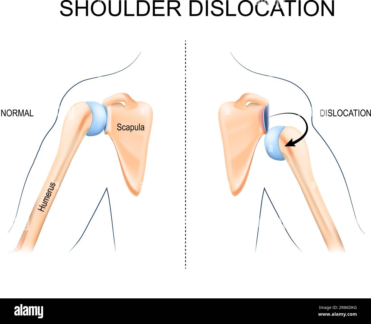 Dislocamento spalla. Trauma osseo omerico, lesioni sportive o muscoli delle spalle deboli. Anatomia del braccio umano. Ossa e articolazione della spalla e della mano. Illustrazione Vettoriale