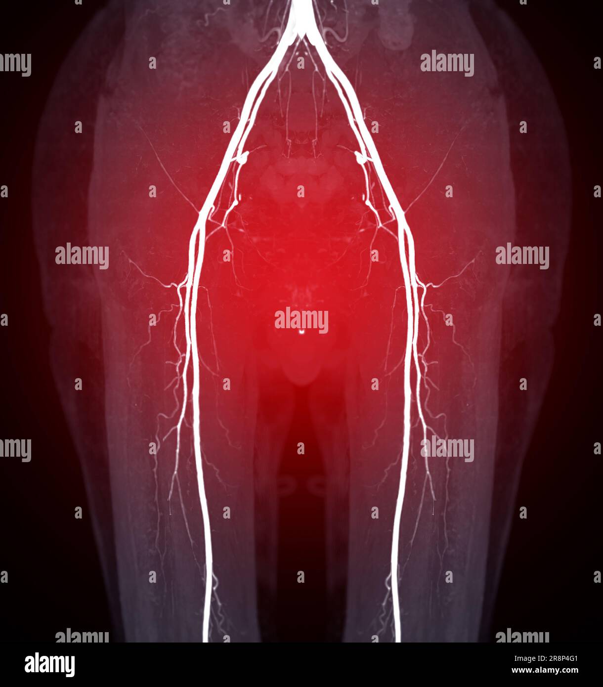 Immagine di scentratura dell'arteria femorale CTA dell'arteria femorale per la patologia arteriosa periferica acuta o cronica diagnostica. Foto Stock