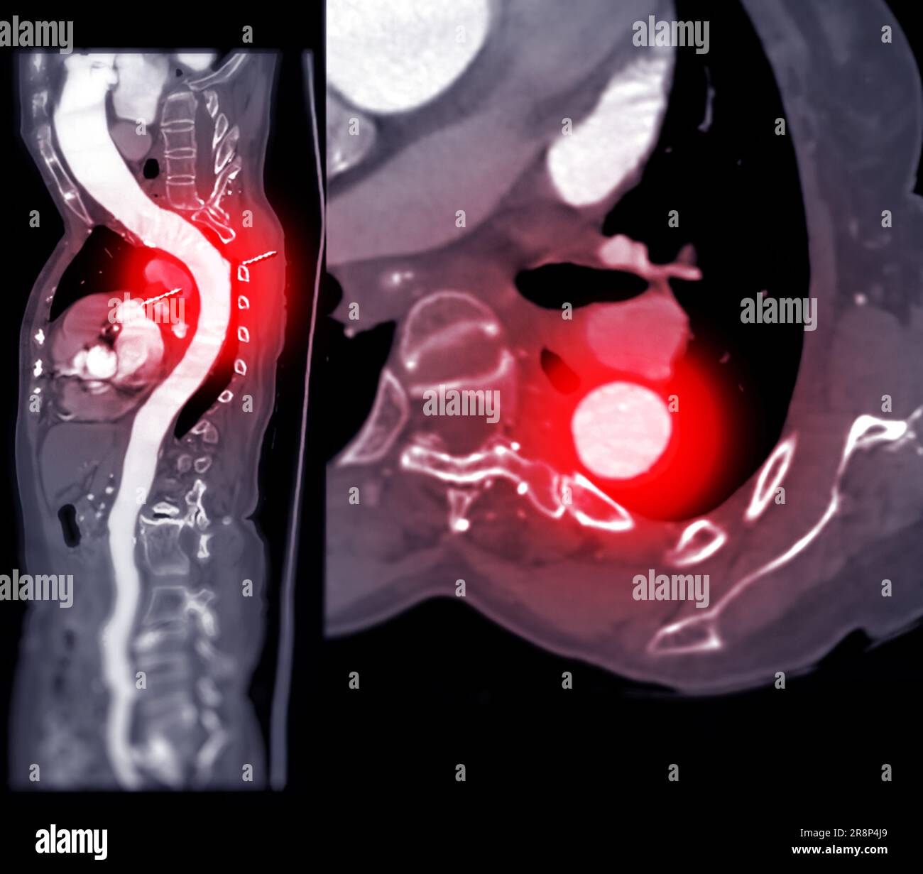 CTA curva MPR aorta intera. Foto Stock