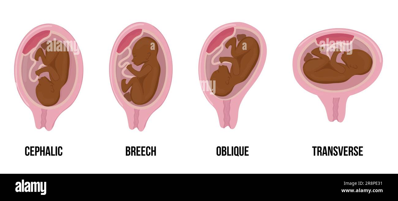 Bambino africano di pelle nera. Diverse posizioni sbagliate del bambino in utero durante la gravidanza. Menzogne cefaliche, culle, trasversali, oblique. Vettore medico colorato Illustrazione Vettoriale