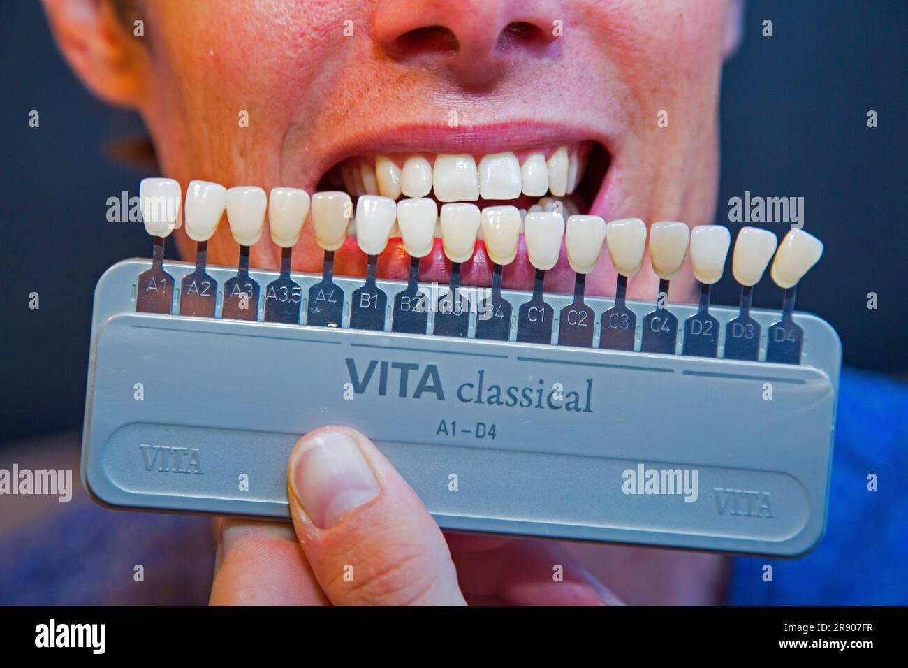 colorazione endogena dei denti