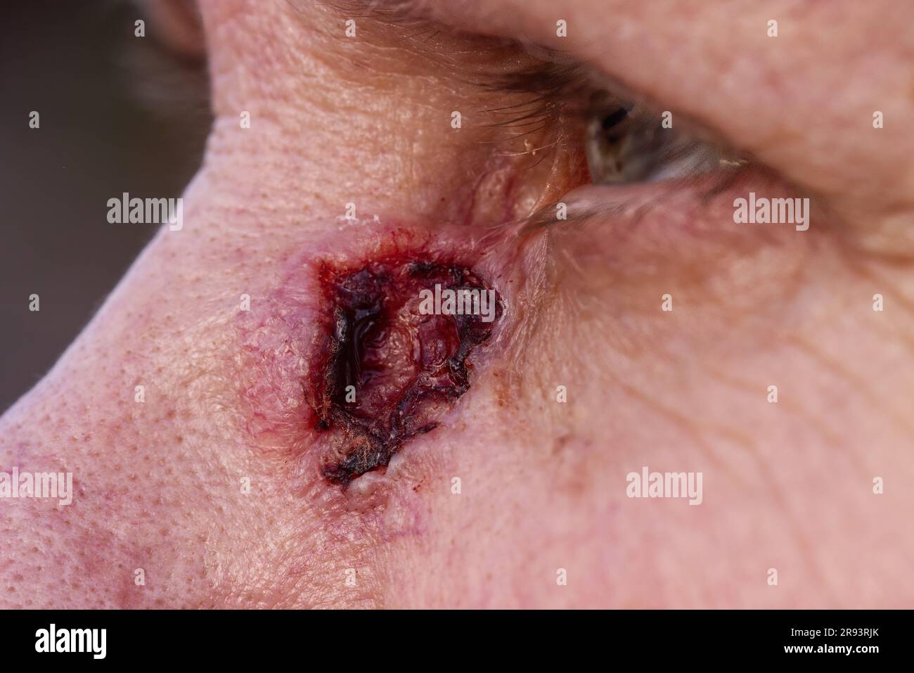 Un primo piano di un carcinoma basale sulla pelle del viso vicino all'occhio Foto Stock