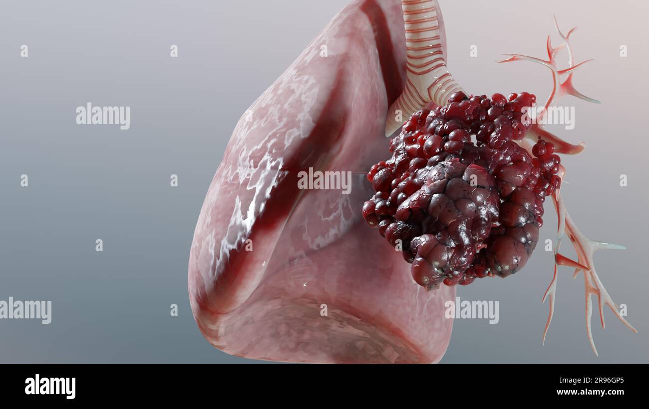 Polmonite malattia, polmoni sani e polmoni malattia, cancro polmonare umano, fumatori di sigaretta malattia polmonare, tumori maligni cancerosi in crescita e spreadina Foto Stock