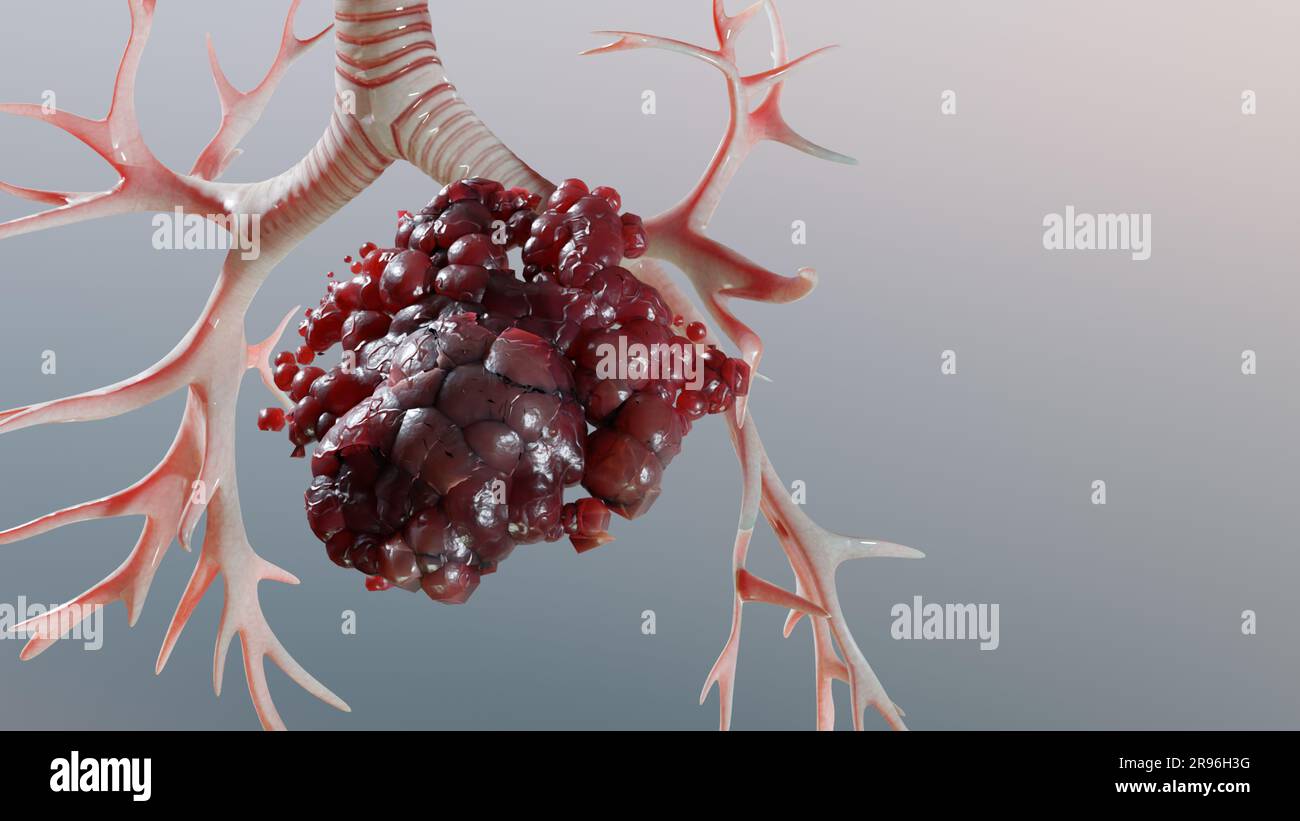 Polmonite malattia, polmoni sani e polmoni malattia, cancro polmonare umano, fumatori di sigaretta malattia polmonare, tumori maligni cancerosi in crescita e spreadina Foto Stock