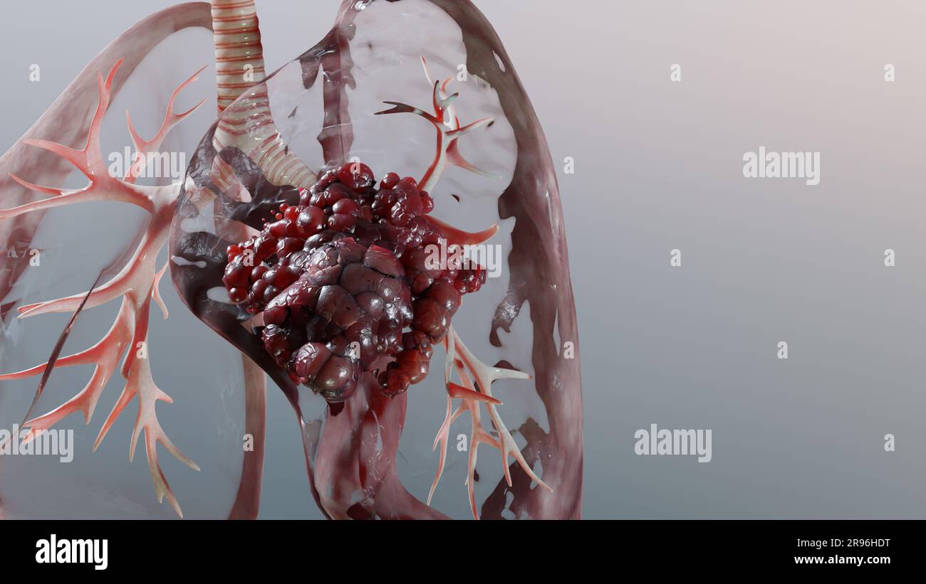 Polmonite malattia, polmoni sani e polmoni malattia, cancro polmonare umano, fumatori di sigaretta malattia polmonare, tumori maligni cancerosi in crescita e spreadina Foto Stock