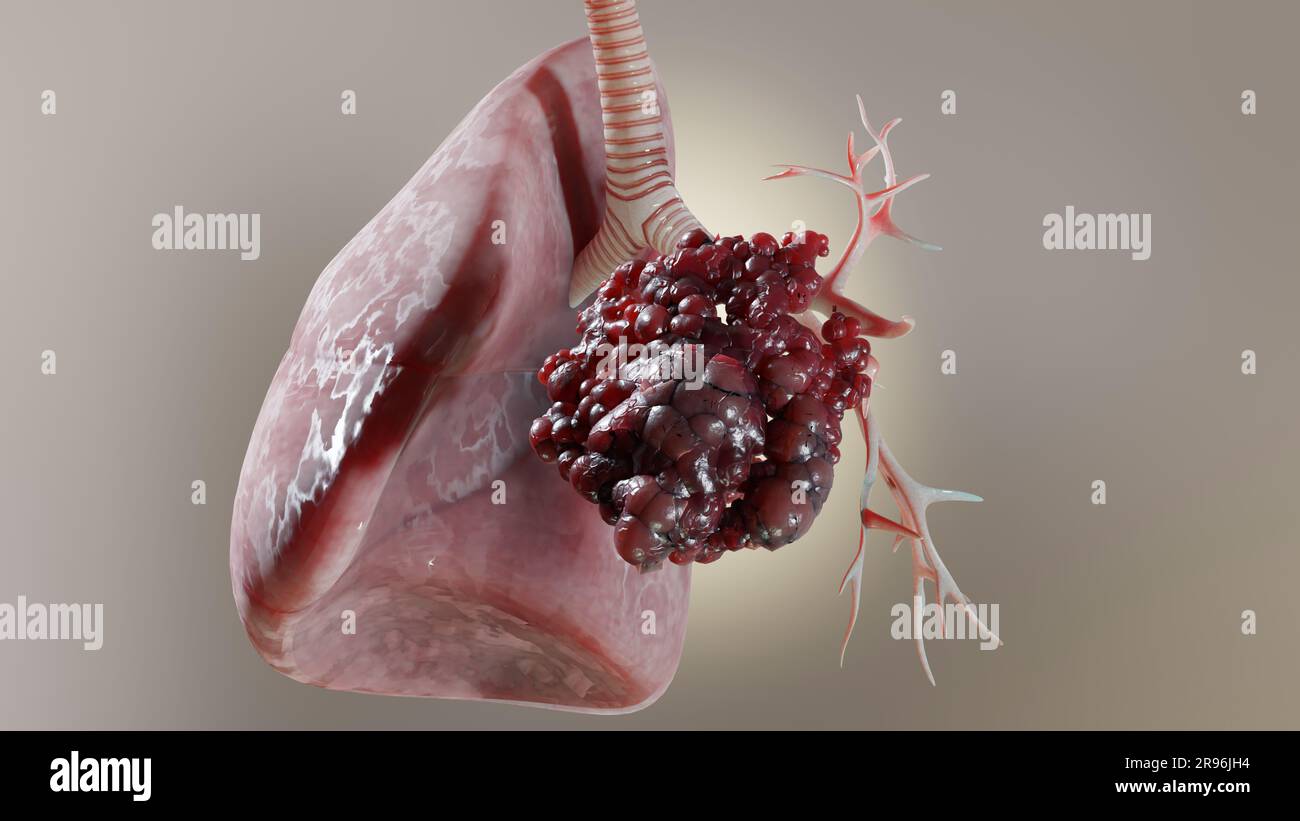 Polmonite malattia, polmoni sani e polmoni malattia, cancro polmonare umano, fumatori di sigaretta malattia polmonare, tumori maligni cancerosi in crescita e spreadina Foto Stock