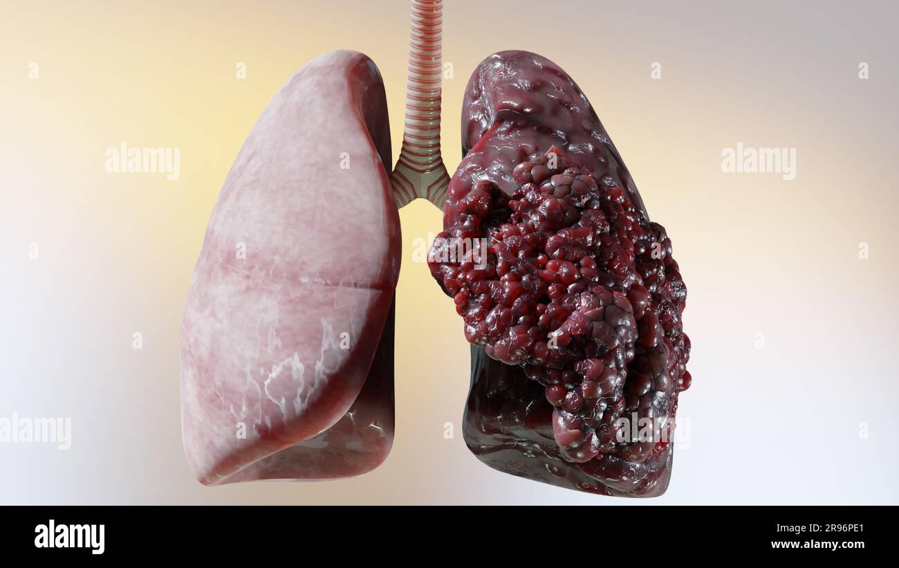 Polmonite malattia, polmoni sani e polmoni malattia, cancro polmonare umano, fumatori di sigaretta malattia polmonare, tumori maligni cancerosi in crescita e spreadina Foto Stock