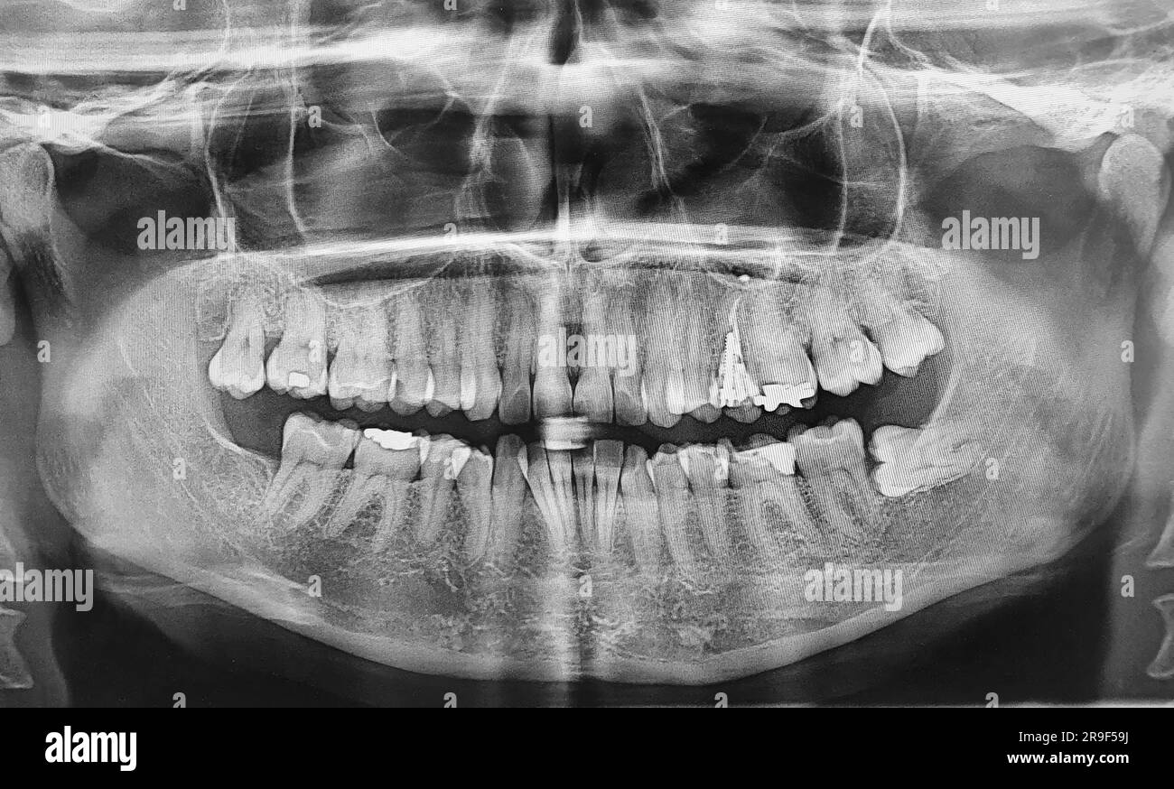 radiografia dentale con dente saggezza influenzato Foto Stock