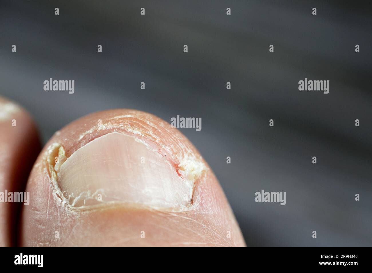 L'unghia incarnita del piede grande è una condizione comune in cui l'angolo o il lato di una coda del piede cresce nella carne morbida provocano dolore, in Foto Stock