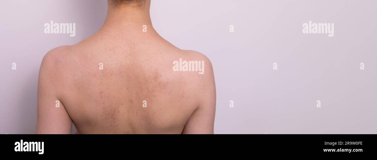 Lividi, capillari rotti dopo la coppettazione, procedura di massaggio anti- cellulite sulla schiena della donna. Sentirsi male, effetto, conseguenze  dopo il massaggio Foto stock - Alamy