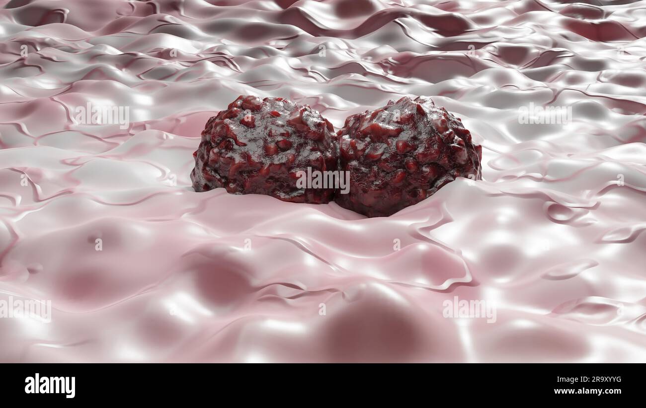 Crescita delle cellule tumorali incontrollabile sui tessuti, cellule di infezione tumorale e diffusione, infiammazione invasiva e metastasi cancerose. riproduci Foto Stock