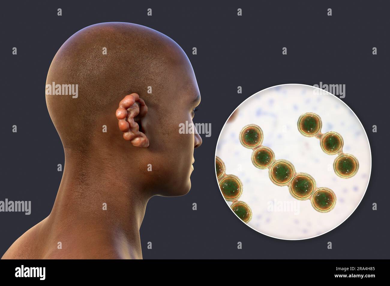 Infezione fungina da Lobomycosis, illustrazione Foto Stock