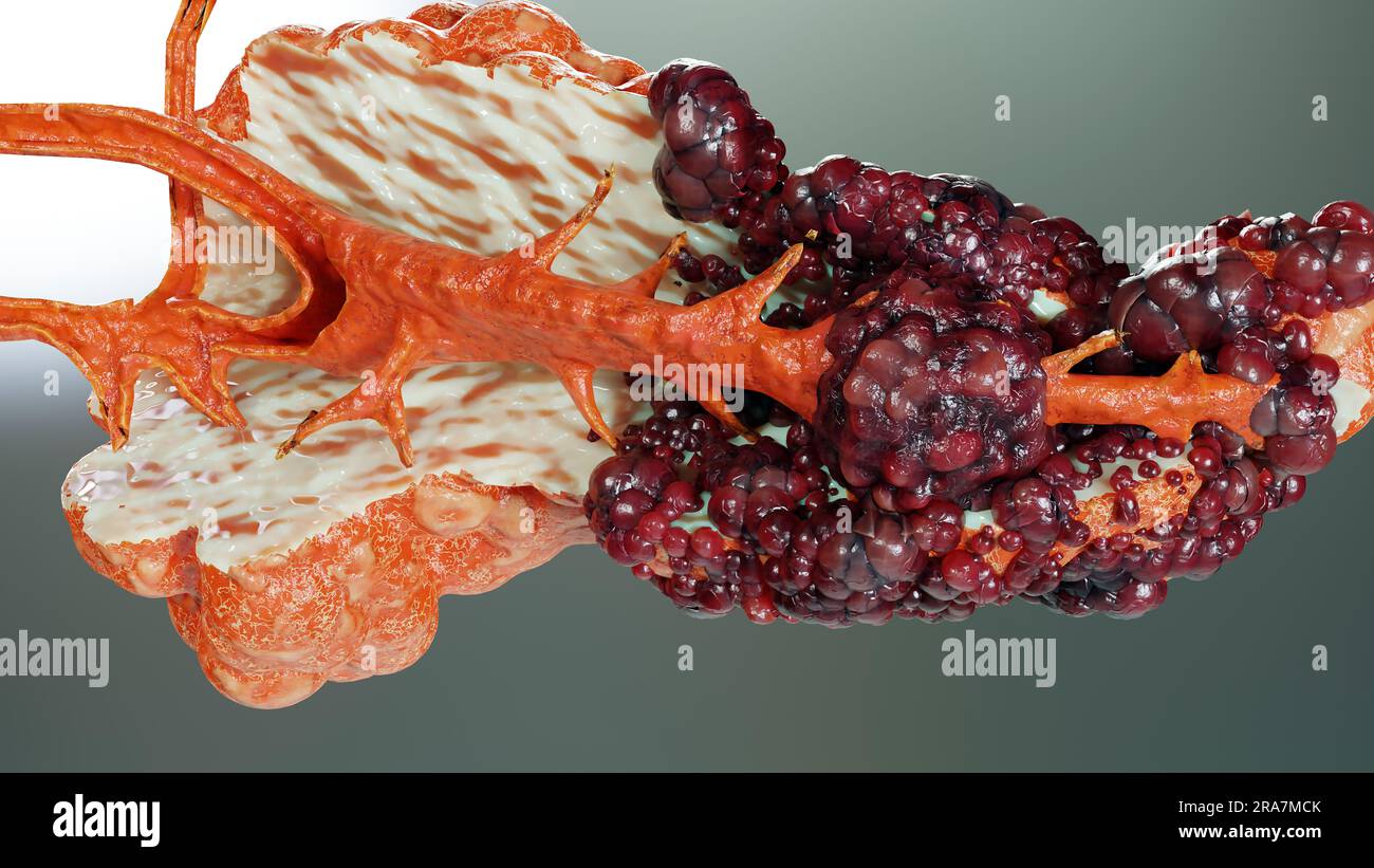 Malattia pancreatica, ghiandola digestiva, diagramma anatomico del cancro del pancreas umano, medico accurato, crescita e diffusione del tumore maligno, cellule mutanti, Foto Stock